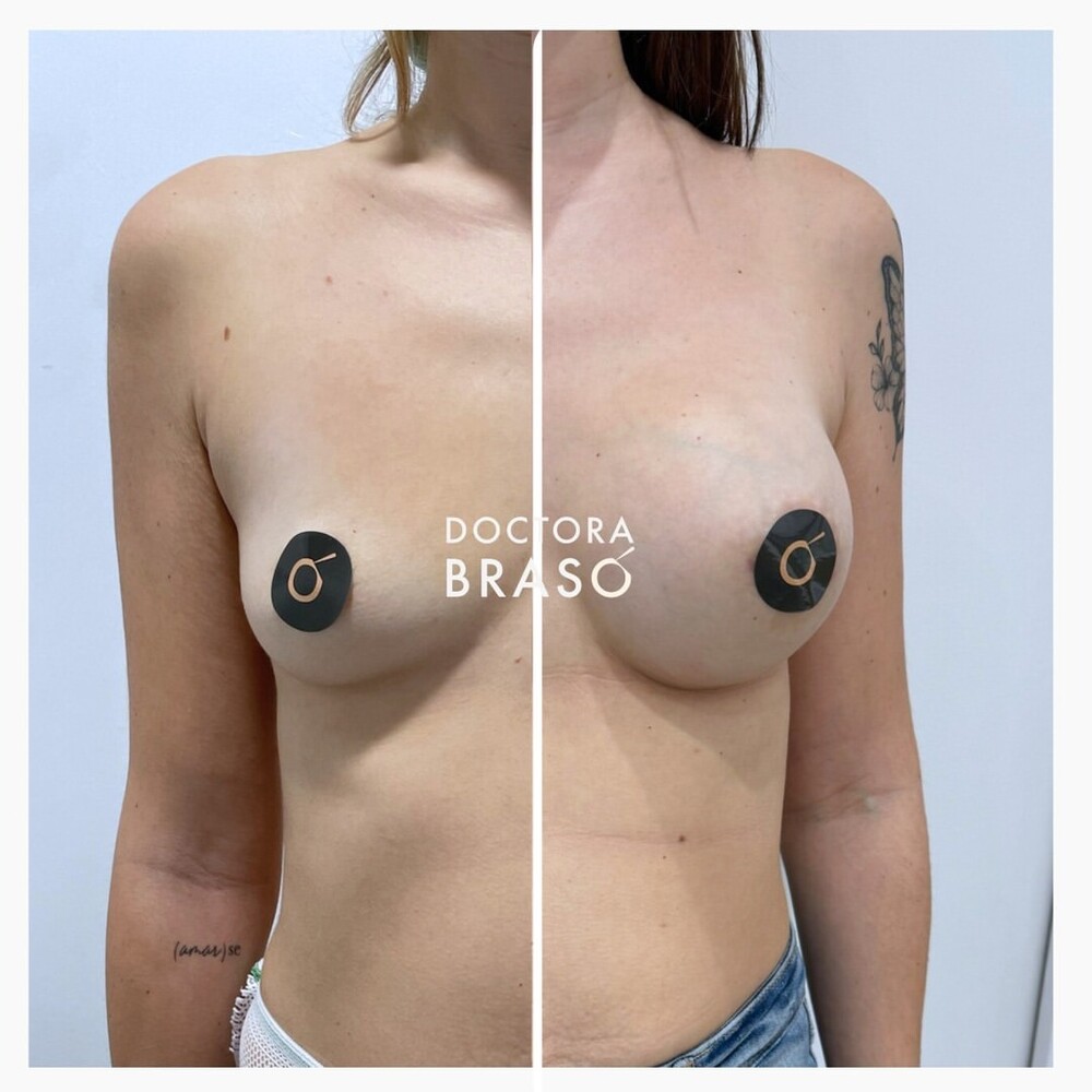 Before and After Result